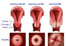Ung thư cổ tử cung - Nguyên nhân, biểu hiện và phương pháp điều trị