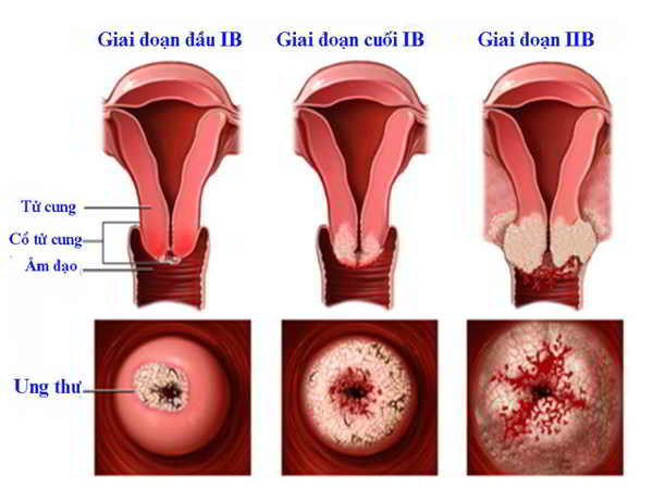 Ung thư cổ tử cung - Nguyên nhân, biểu hiện và phương pháp điều trị